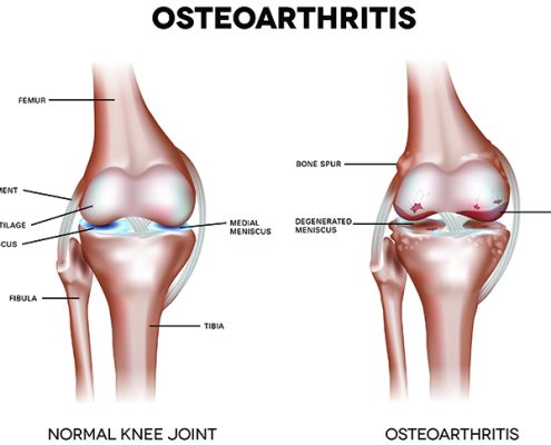 osteoarthritis