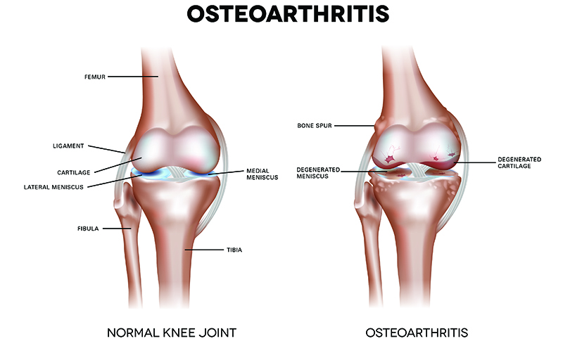 Osteoarthritis knee joint diagram cartilage inflammation and regenerative medicine planning