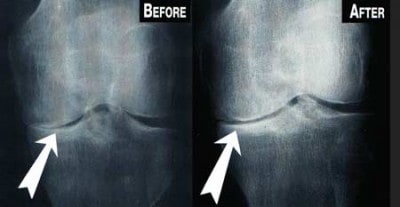 Stem cell therapy for osteoarthritis Malaysia joint pain regenerative medicine review