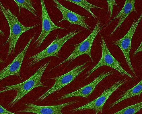 Bone Marrow Stem Cells